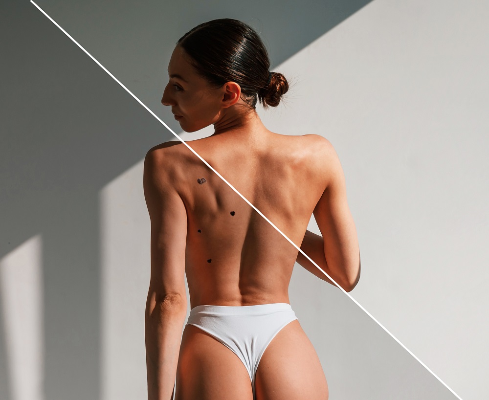 Удаление папиллом лазером